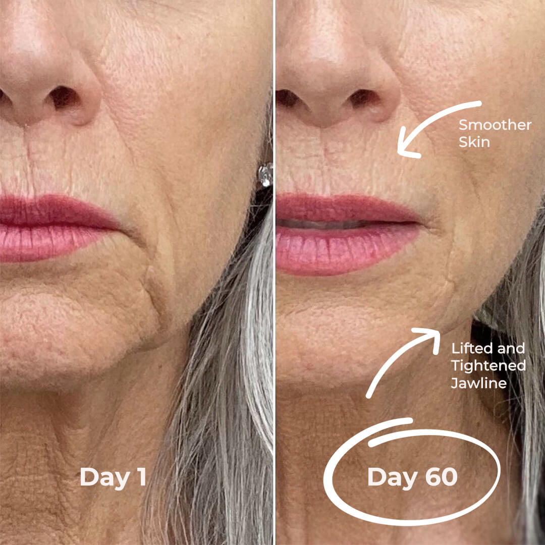 5MinSkin MicroSculpt + Hyaluronzuur Serum (30 Dagen Voorraad)